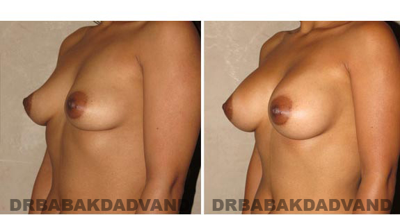 Breast-Augmentation. Before & After Photos - Woman, left side, oblique view
