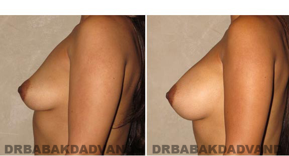 Breast-Augmentation. Before & After Photos - Woman, left side view