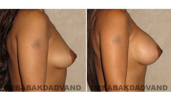 Breast-Augmentation. Before & After Photos - Woman, right side view