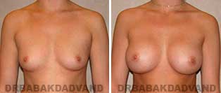 Breast Augmentation. Before & After Photos. 26 yr old woman frontal view