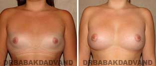 Breast Augmentation. Before and After Photos. 19 year old woman - front view