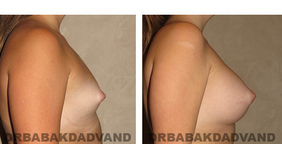Before & After Photos. Breast-Augmentation: - 19 year old woman, right side view