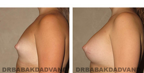 Before & After Photos. Breast-Augmentation: - 19 year old woman, left side view