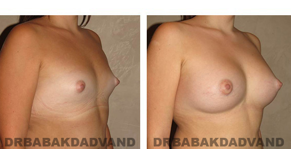 Before & After Photos. Breast-Augmentation: - 19 year old woman, right side, oblique view