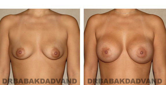 Before & After Photos. Breast-Augmentation: - 32 year old female, front view
