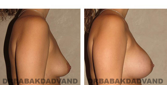 Before & After Photos. Breast-Augmentation: - 32 year old female, right side view