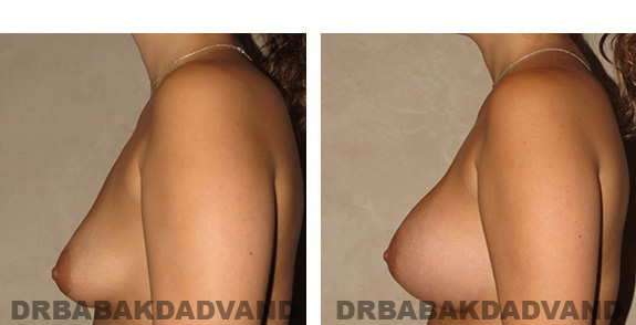 Before & After Photos. Breast-Augmentation: - 32 year old female, left side view