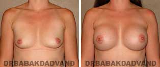 Breast Augmentation. Before and After Photos. 30 year old woman - front view