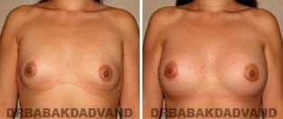 Breast Augmentation. Before and After Photos. 26 year old female - front view