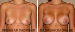 Breast Augmentation. Before and After Photos. 28 year old woman - front view