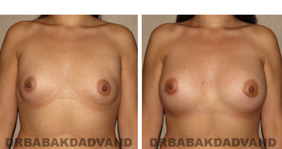 Before and After Photos. Breast-Augmentation: - 26 year old female, front view