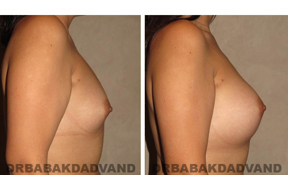 Before and After Photos. Breast-Augmentation: - 26 year old female, right side view