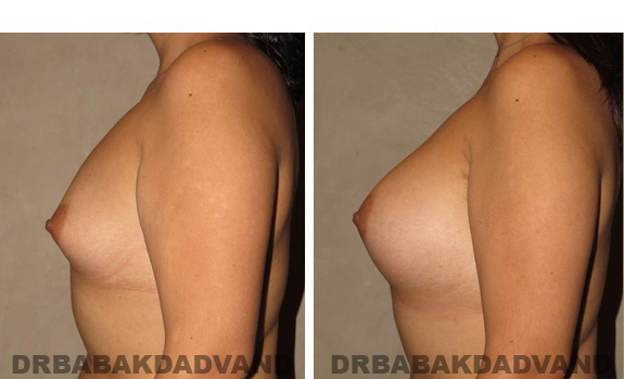 Before and After Photos. Breast-Augmentation: - 26 year old female, left side view