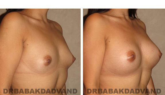 Before and After Photos. Breast-Augmentation: - 26 year old female, right side, oblique view