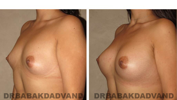 Before and After Photos. Breast-Augmentation: - 26 year old female, left side, oblique view