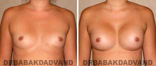 Breast Augmentation. Before and After Photos. 23 year old woman - front view