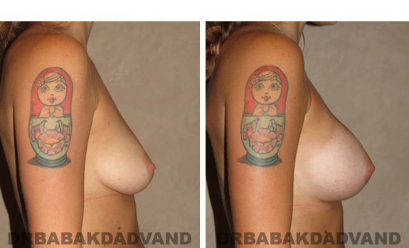 Before and After Photos. Breast-Augmentation: - 28 year old female, right side view