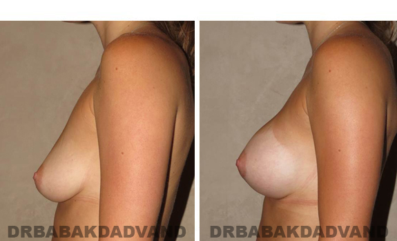 Before and After Photos. Breast-Augmentation: - 28 year old female, left side view