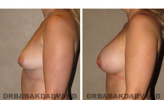 Before and After Photos. Breast-Augmentation: - 31 year old female, left side view