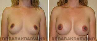 Breast Augmentation. Before & After Photos. 35 yr old woman frontal view