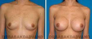 Breast Augmentation. Before & After Photos. 26 year old female frontal view
