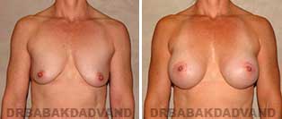Breast Augmentation. Before & After Photos. 40 year old female frontal view