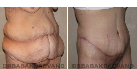 Before - After Photos |Bodylift| 55 year old female, - right side,oblique view