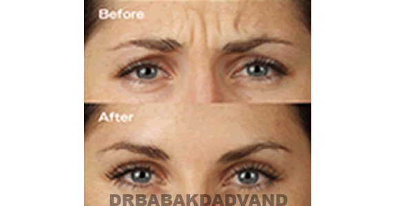 Before - After Photos |Botox| female