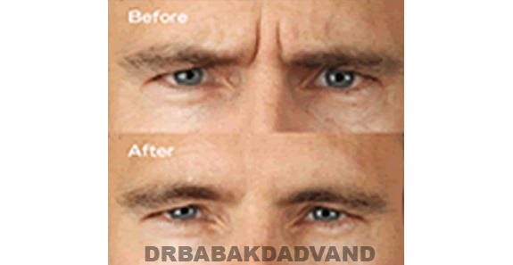 Before - After Photos |Botox| male