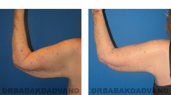 Before - After Photos |Brachioplasty| 66 year old female, left hand, back view