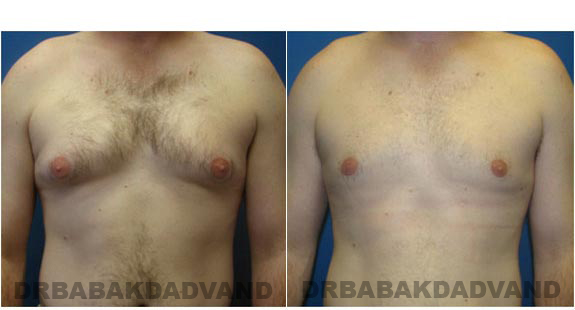 Before and After Photos. Breast-Gynecomastia: - 28 year old male, front view