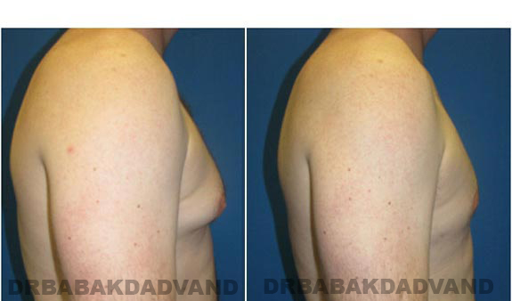 Before and After Photos. Breast-Gynecomastia: - 28 year old male, right side view