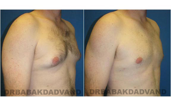 Before and After Photos. Breast-Gynecomastia: - 28 year old male, right side, oblique view
