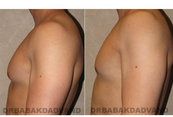 Breast-Gynecomastia: Before and After Photos. 26 year old man, left side view