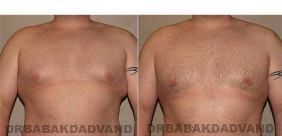 Breast-Gynecomastia: Before and After Photos. 28 year old man, - front view