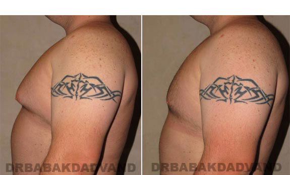 Breast-Gynecomastia: Before and After Photos. 28 year old man, -left side view