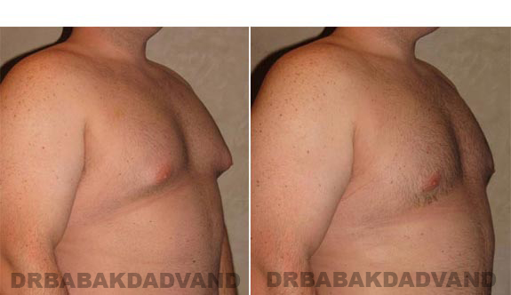 Breast-Gynecomastia: Before and After Photos. 28 year old man, -right side, oblique view