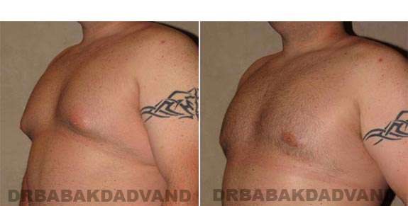 Breast-Gynecomastia: Before and After Photos. 28 year old man, -left side, oblique view
