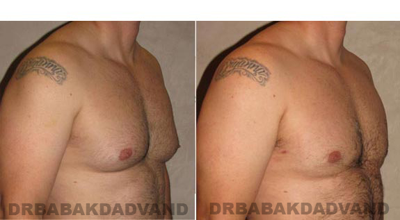 Breast-Gynecomastia: Before and After Photos. 39 year old man, -right side, oblique view