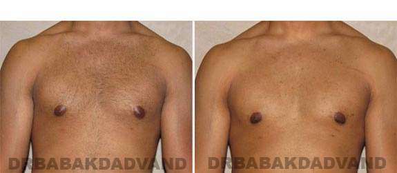 Breast-Gynecomastia: Before and After Photos. 23 year old man, - front view