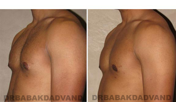 Breast-Gynecomastia: Before and After Photos. 23 year old man, -left side, oblique view