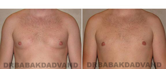 Before and After Photos -Gynecomastia - 28 year old male, - front view