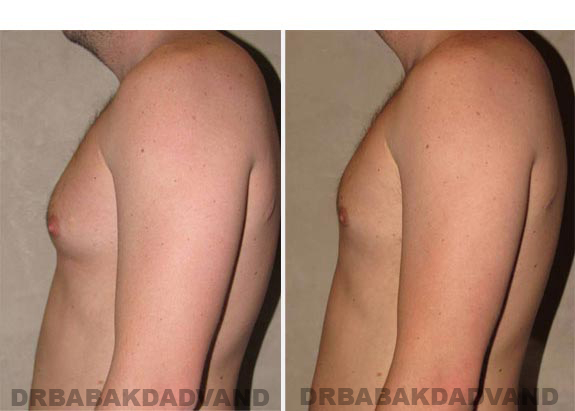 Before and After Photos -Gynecomastia - 28 year old male, -left side view