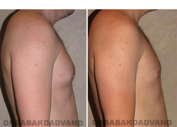 Before and After Photos -Gynecomastia - 28 year old male, -right side view