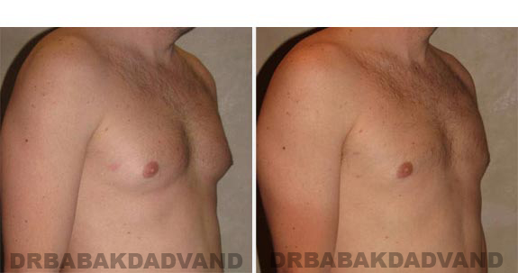 Before and After Photos -Gynecomastia - 28 year old male, -right side, oblique view