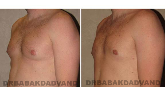 Before and After Photos -Gynecomastia - 28 year old male, -left side, oblique view