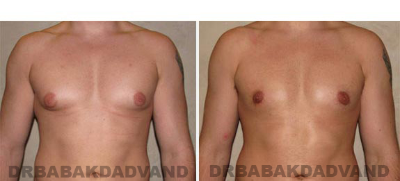 Breast-Gynecomastia: Before and After Photos. 24 year old man, - front view