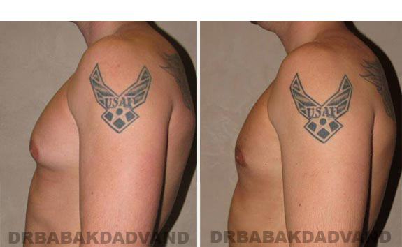Breast-Gynecomastia: Before and After Photos. 24 year old man, -left side view