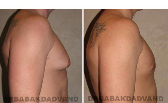 Breast-Gynecomastia: Before and After Photos. 24 year old man, -right side view