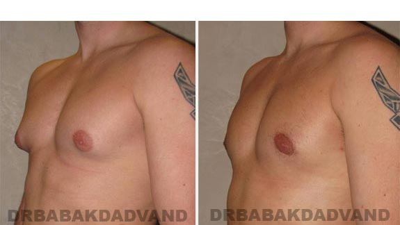 Breast-Gynecomastia: Before and After Photos. 24 year old man, -left side, oblique view
